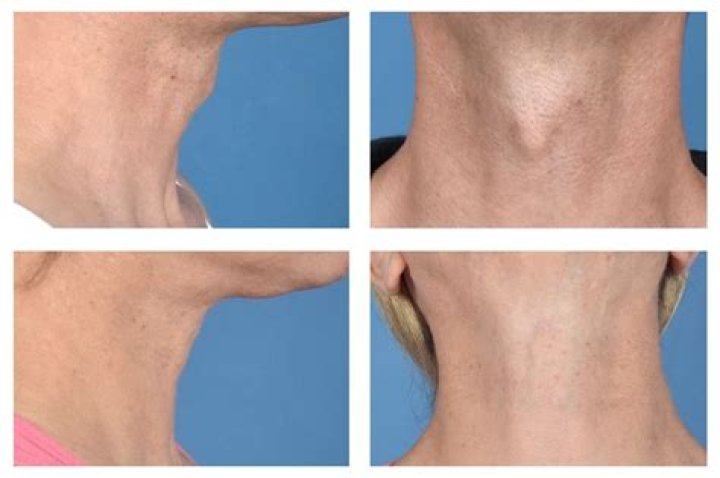 Bruce Jenner Shows Off New Neck After Adam’s Apple Surgery